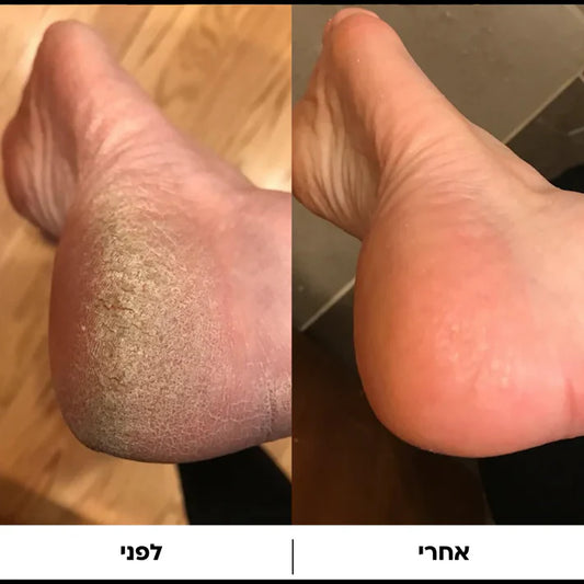 ™Pedi - מכונה להסרת עור יבש וסדקים בכפות הרגליים