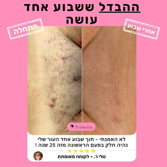 סכין גילוח מתקדמת לעור חלק ללא גירויים ושערות חודרניות - Silk Razor