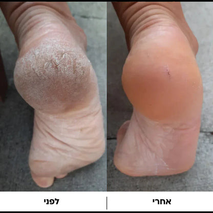 מכונת הפדיקור של טרימלה – Pedi™