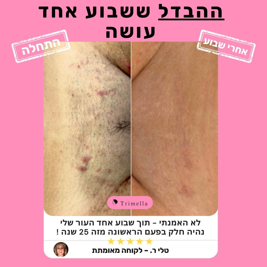 סכין גילוח מתקדמת לעור חלק ללא גירויים ושערות חודרניות - Silk Razor