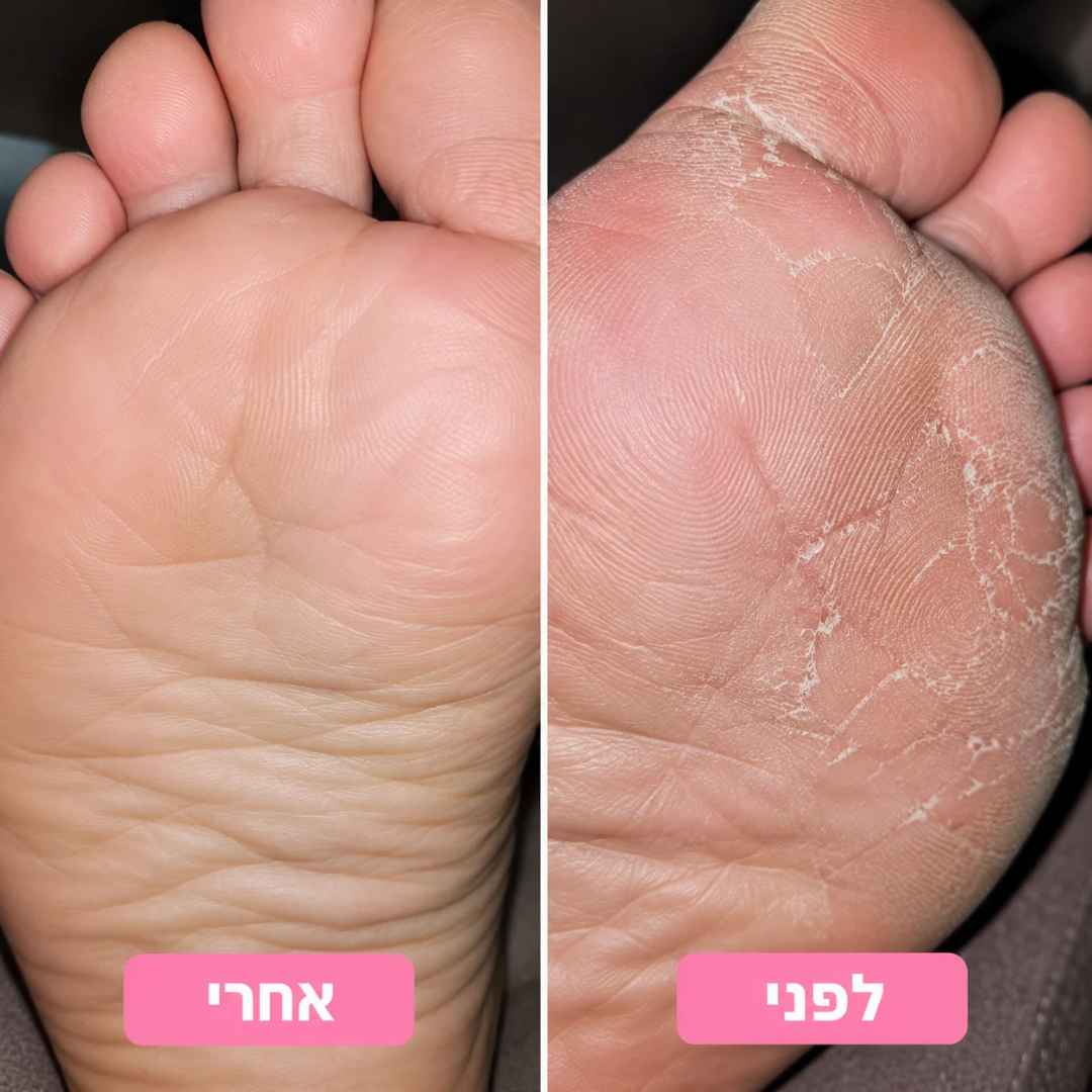 סבון טיפולי ליובש, גרד ועור הנוטה לפטריות