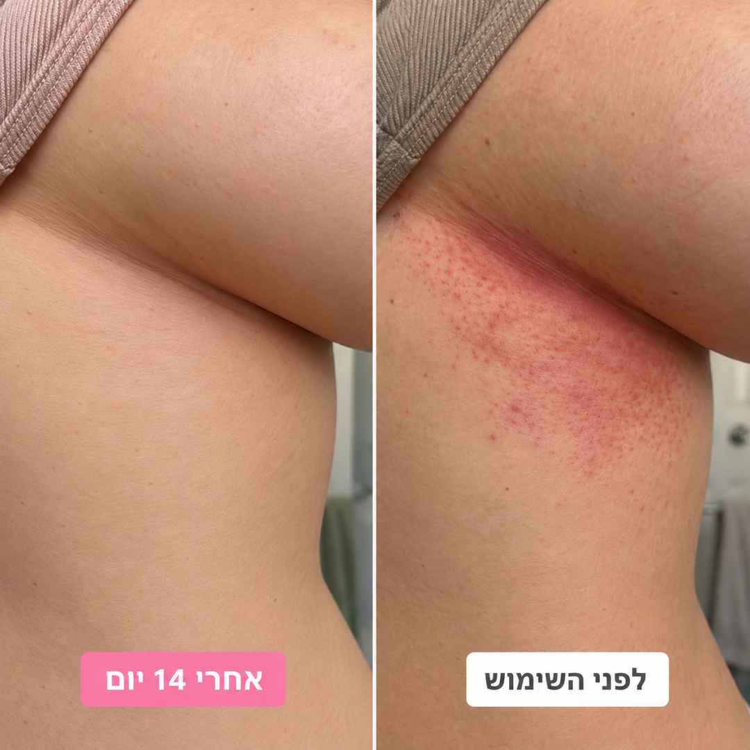 קרם ייעודי להרגעת שפשפות בקפלי העור, להפחתת גירוי ולהחזרת תחושת נוחות יומיומית