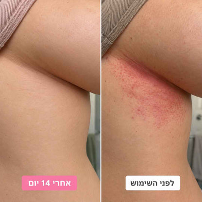 קרם ייעודי להרגעת שפשפות בקפלי העור, להפחתת גירוי ולהחזרת תחושת נוחות יומיומית